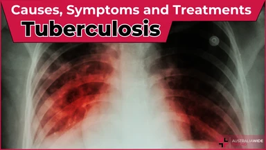 Tuberculosis article header – First Aid Course Laverton Tuberculosis article header – First Aid Article in Laverton